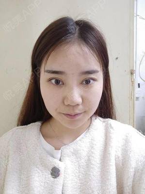 双眼皮术后多久可以洗脸