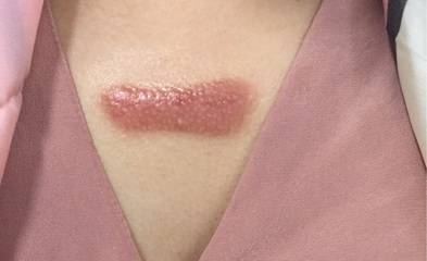 痘痘怎么能治好