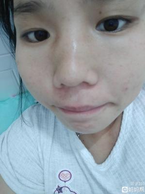 鼻子老是红长痘痘