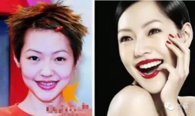 牙套会改变脸型吗