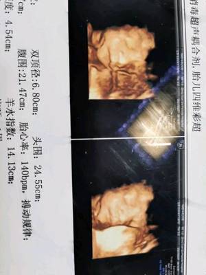 梦见孕妇羊水破了