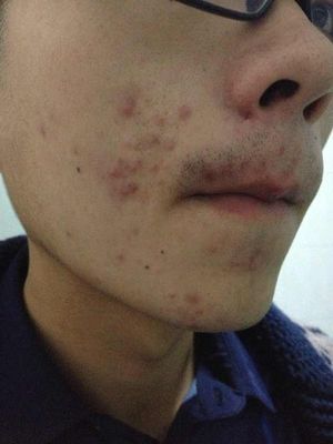 为什么脸部出油严重