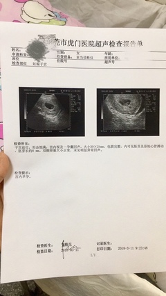 怀孕2个月最准看男女
