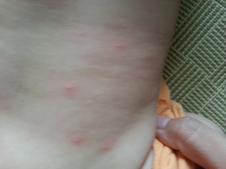 后背受潮起痘痘