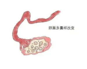 卵巢多囊样改变怎么治疗