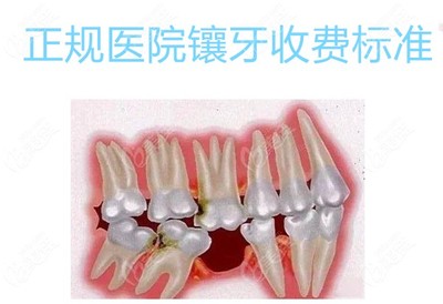 镶一个烤瓷牙多少钱
