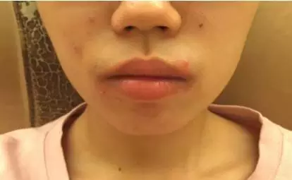 嘴唇边上长痘痘肿了
