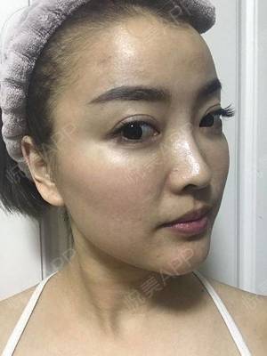 微针过后几天可以化妆