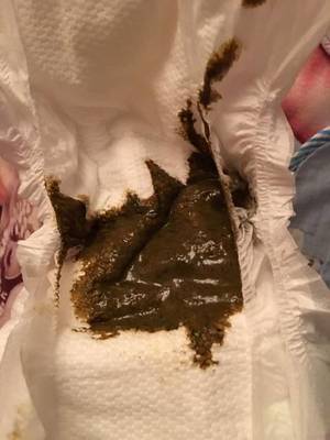 一岁宝宝拉黑色大便怎么回事