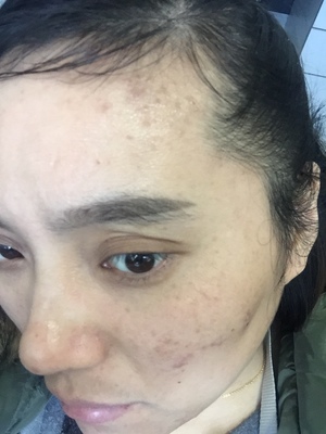 擦脸油痘痘多