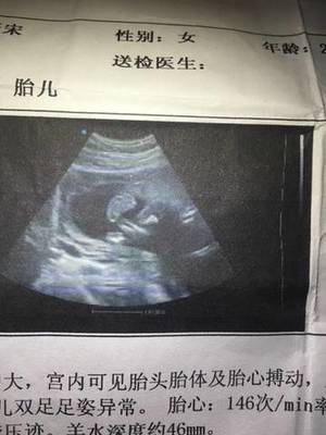 引产胎儿是活的吗