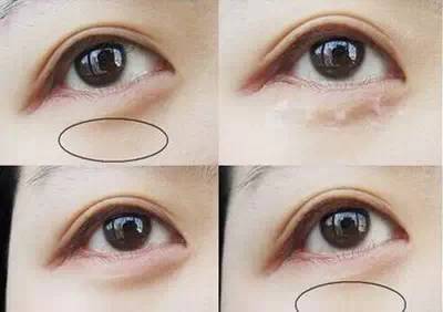 眼部脂肪粒如何去除