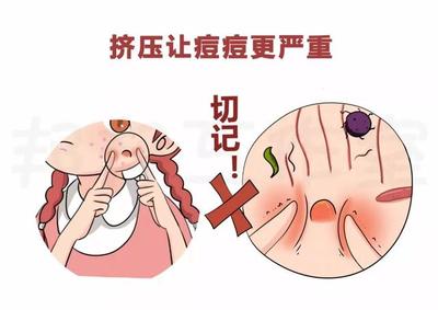 痘痘挤压变成色素