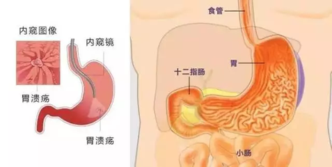 胃溃疡伴出血怎么治疗