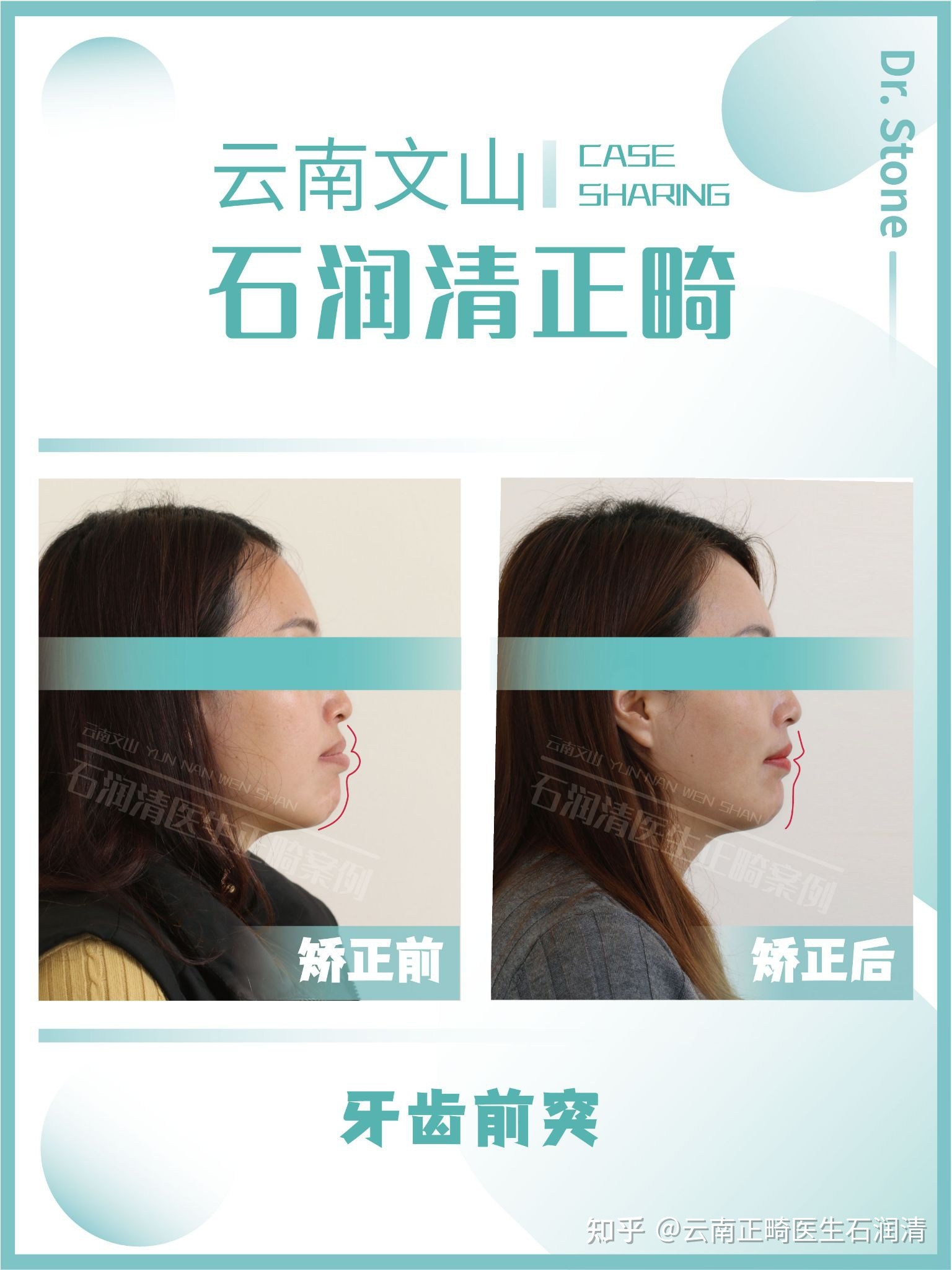文山牙齿矫正