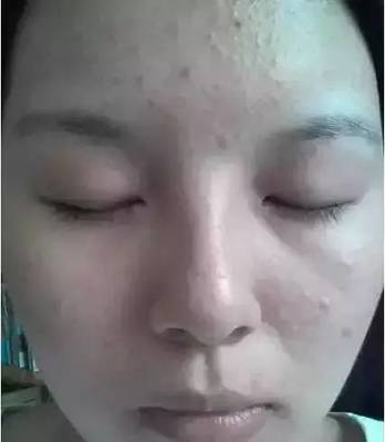 痘痘什么情况可以挤