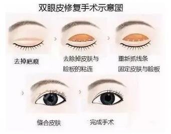 眼部黄褐斑