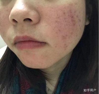 痘痘男護膚哪個好