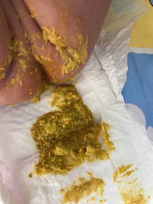 宝宝大便有块状物图片