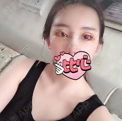 小眼角充血是怎么回事