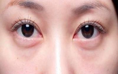 眼袋大是怎么回事