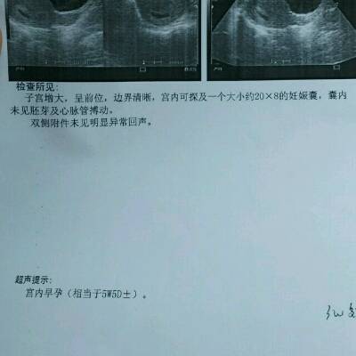 怀孕多少周有胚芽