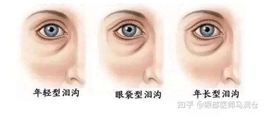 眼部脂肪填充