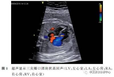 左心脏增大是怎么回事