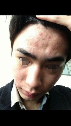 做眉毛脸上起痘痘