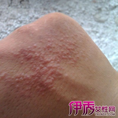 孕妇汗疱疹怎么治疗