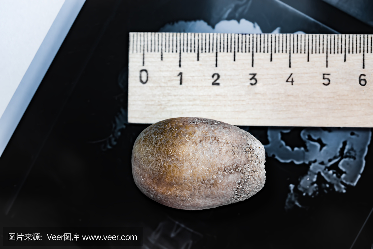 一个大结石从胆囊的背景和内脏器官的x光线上形成时,结石性胆囊炎,胆.