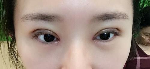 怎样才能有双眼皮