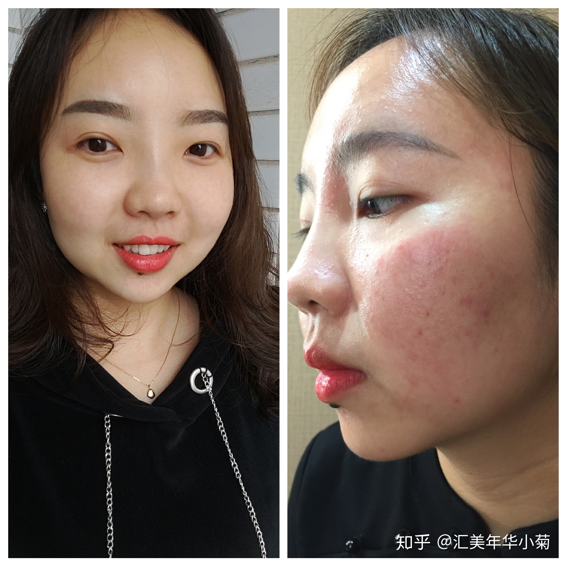 长痘痘痤疮不能吃什么东西
