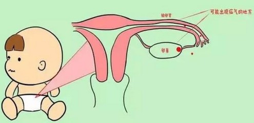 小儿疝气是怎么回事