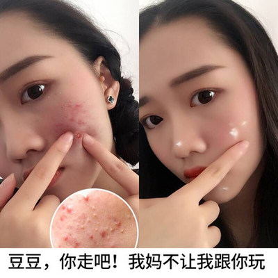 痘痘和粉刺啥区别