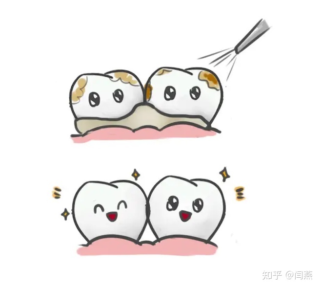 洗牙原理