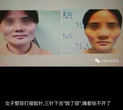 瘦脸针为什么会凹陷
