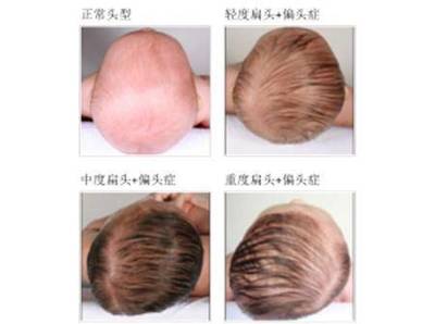 后脑勺都是痘痘