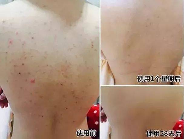 胸脯上长痘痘怎么去掉