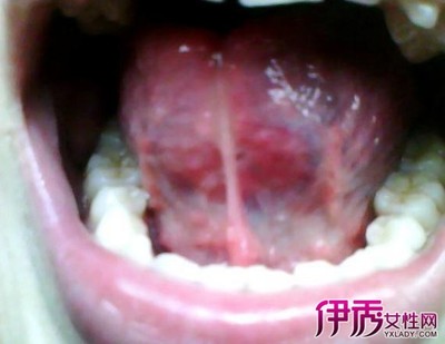 口腔黏膜病怎么治疗