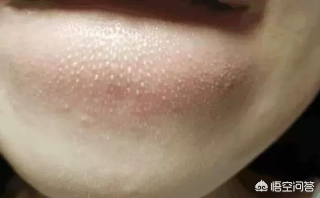 鼻子有痘痘能挤吗