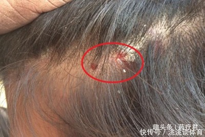 头皮周围还有里面长痘痘