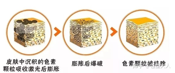 爆破祛斑对皮肤的伤害