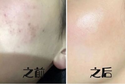 脸上痘印怎么消