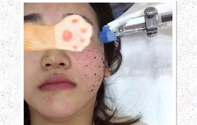 水光针两天可以化妆吗
