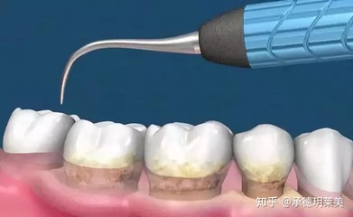洗牙原理