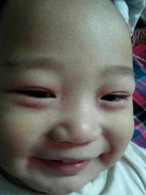 10个月宝宝过敏起红疹