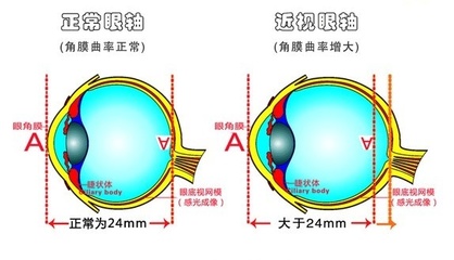 角膜厚度多少可以做近视手术