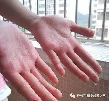 汗是凉的怎么回事