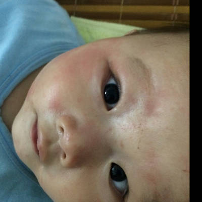 五个月宝宝出疹子怎么办